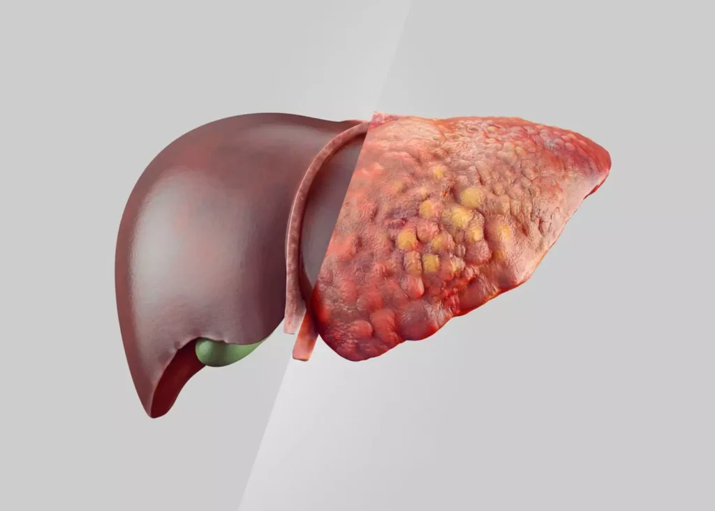 Liver disease